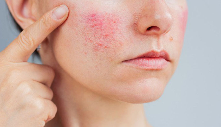Azelaic Acid for Rosacea 